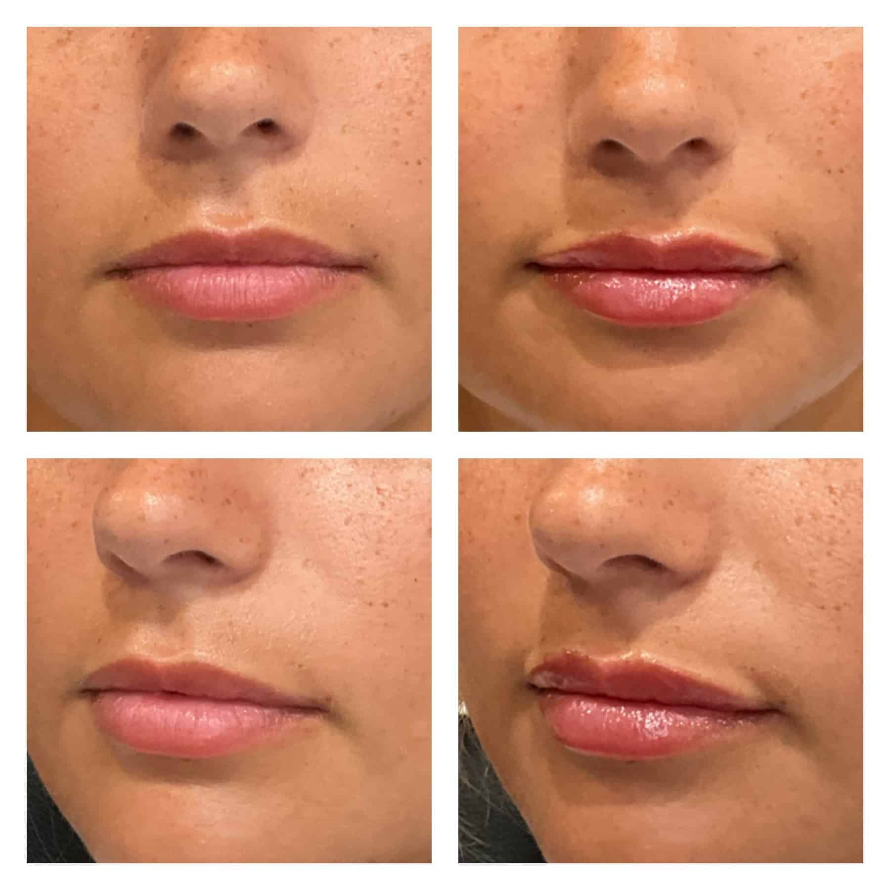 Before and after lip filler in Scottsdale – enhanced volume and cupid’s bow definition