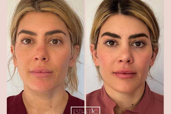1_20250103_034901_0000 Phoenix client Botox result – natural softening of crow’s feet and frown lines