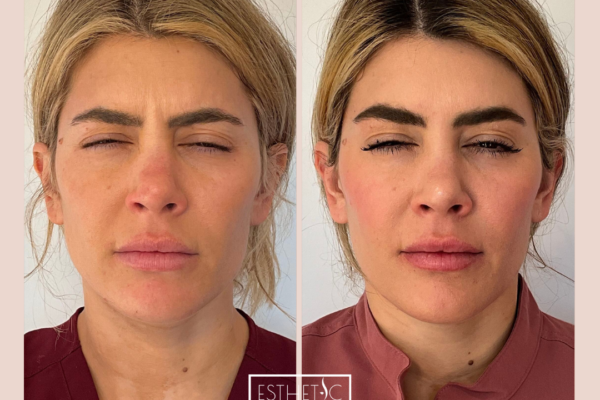 2_20250103_034901_0001 Botox injection syringe used in Phoenix treatment at Esthetic Finesse