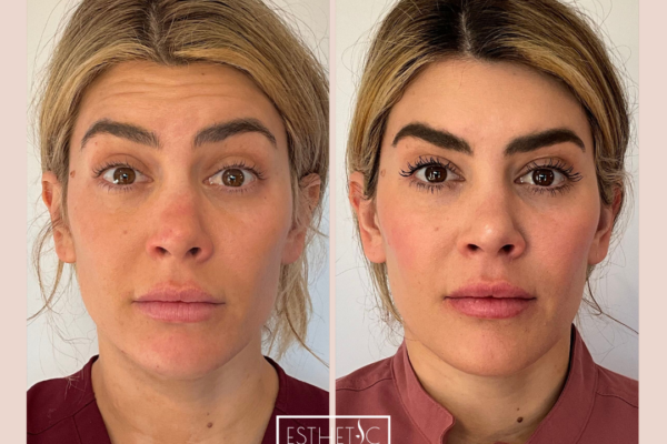 3_20250103_034901_0002 Natural Botox wrinkle reduction on forehead - Phoenix client