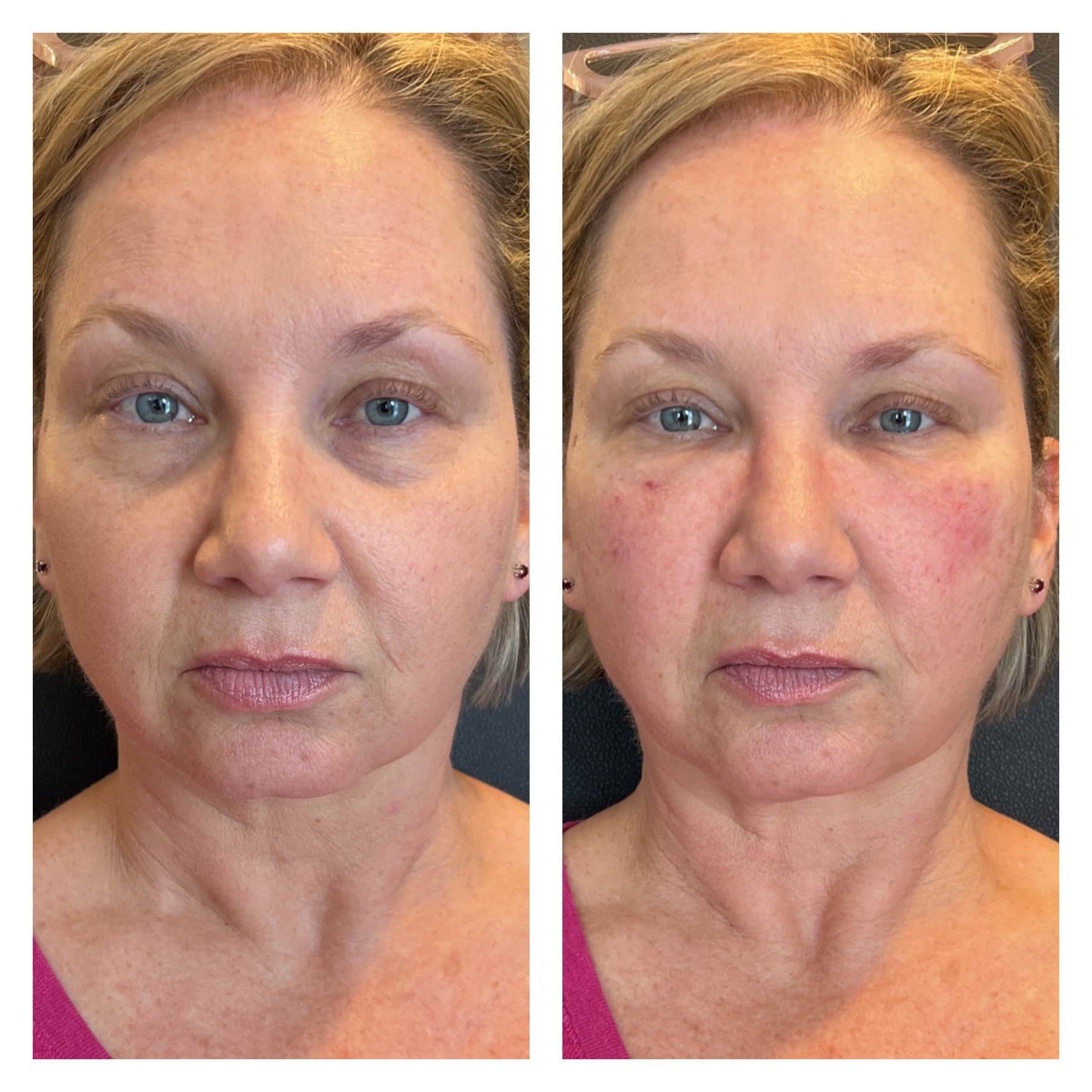 vampire facial treatment nurse diane scottsdale