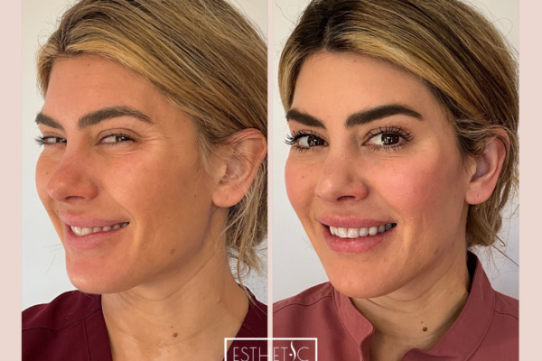 4_20250103_034901_0003 how Botox works to reduce wrinkles – Esthetic Finesse graphic