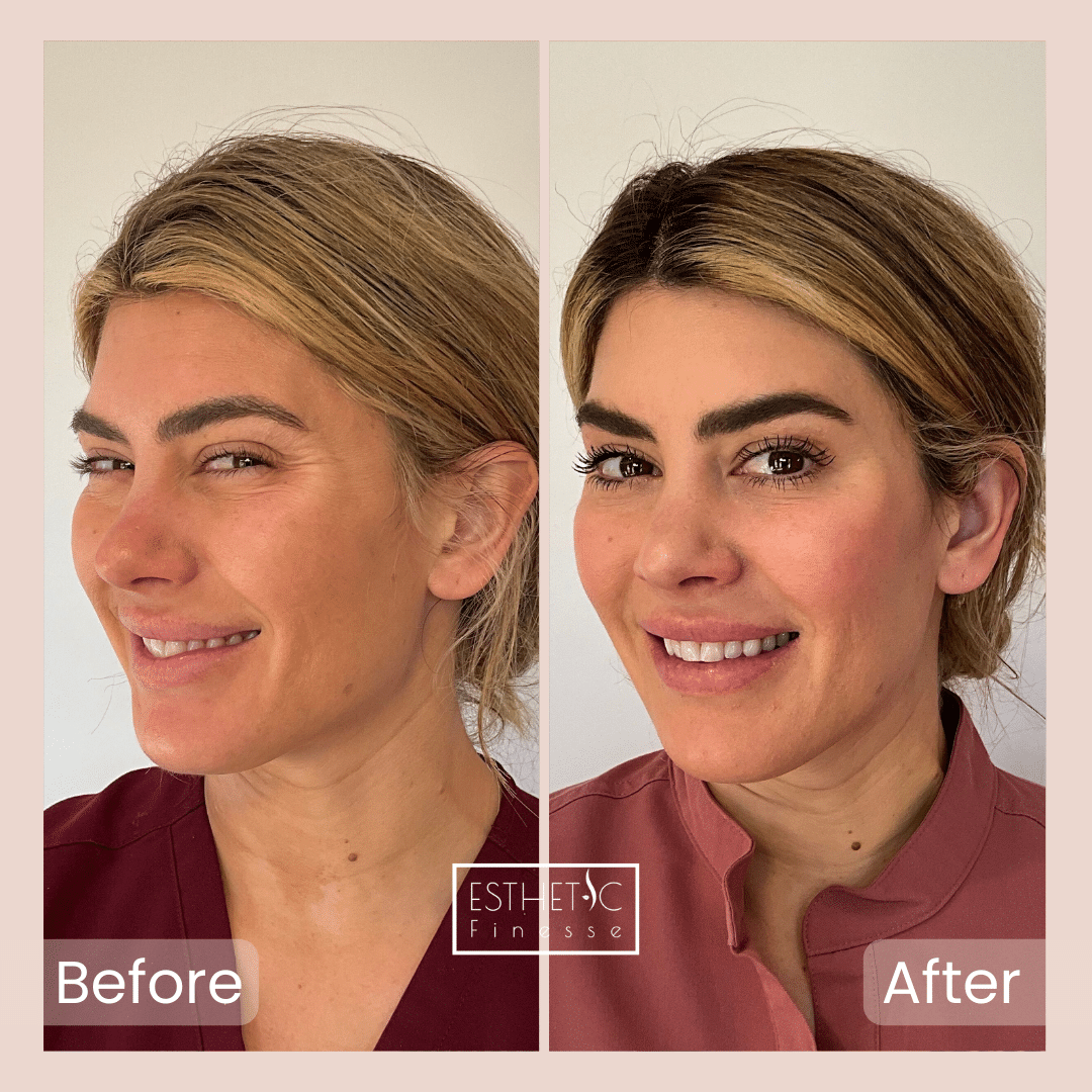 how Botox works to reduce wrinkles – Esthetic Finesse graphic