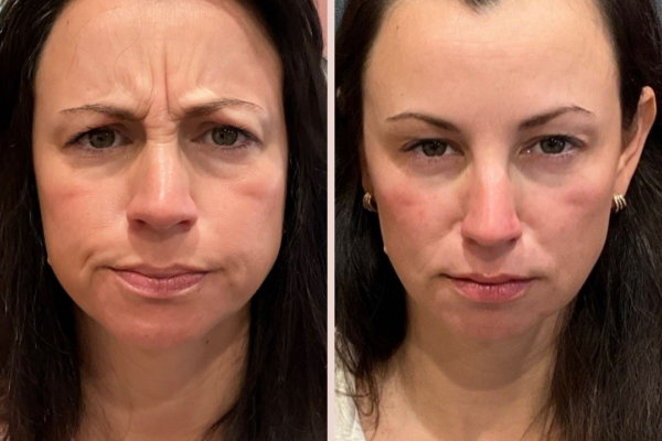 Ali Molina's Dysport_20250209_023444_0000 How Botox works to reduce facial wrinkles - Esthetic Finesse