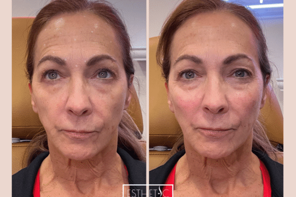 radiesse natural results