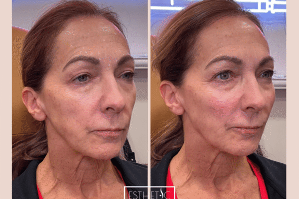 PRF and Radiesse combo treatment for skin quality and structure