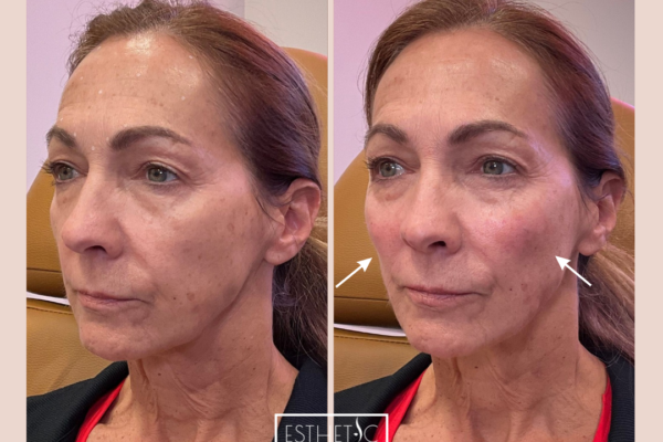 Radiesse injection results for cheeks and chin – profile balancing