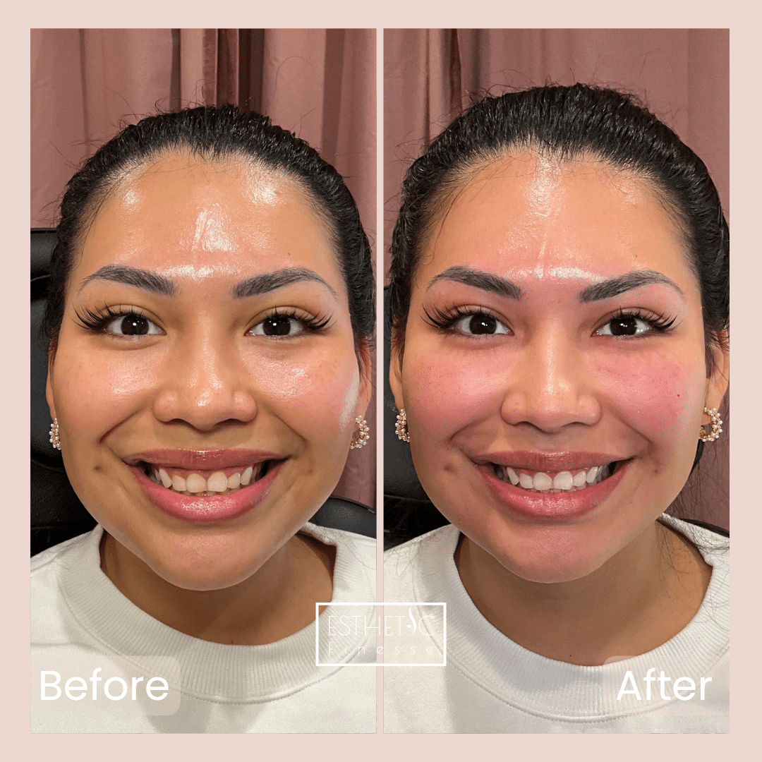 Bianca Fuentes' PRF Gel (Under Eye, Nasal Folds, Chin)_20250103_032053_0000