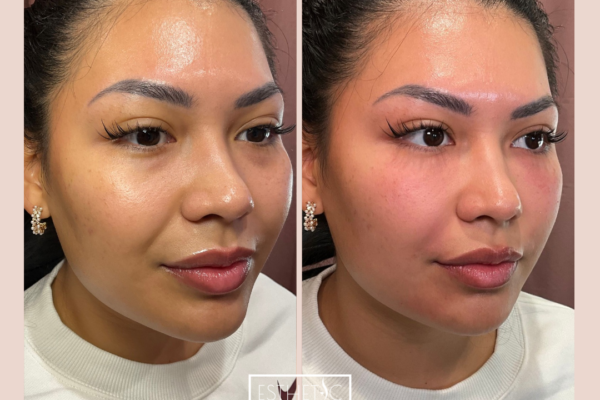 Client under eye transformation with platelet-rich fibrin – safe, filler-free results