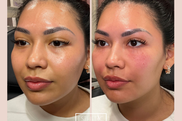 Before and after PRF EZ Gel treatment in Scottsdale – natural under eye rejuvenation