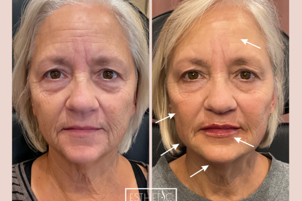 Julie Wilkens Full Restore Botox, Cheek filler, Jawline, Chin, Lips_20250103_035828_0000 Before and after Botox treatment in Phoenix – forehead lines reduction