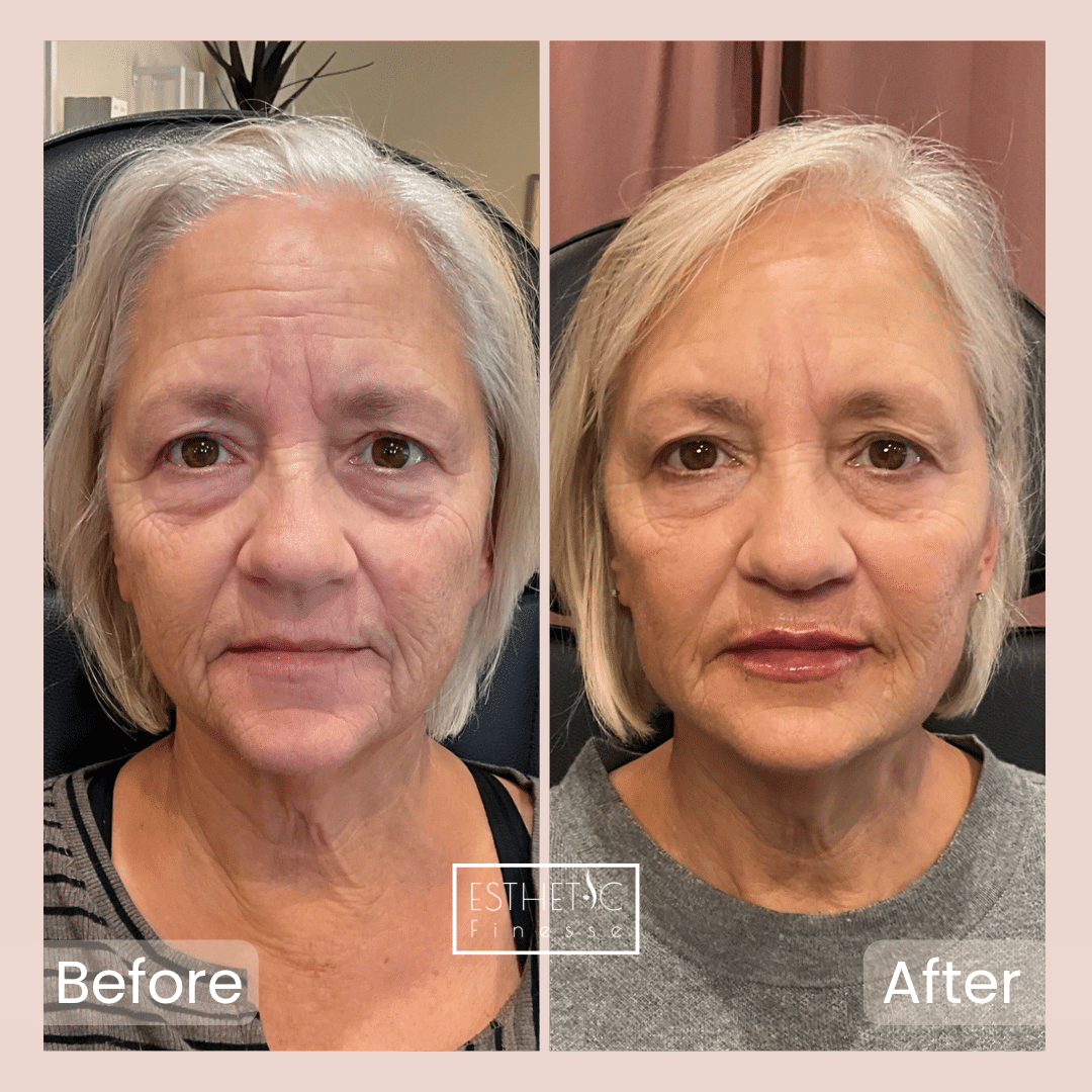 Happy Botox client after treatment in Phoenix clinic