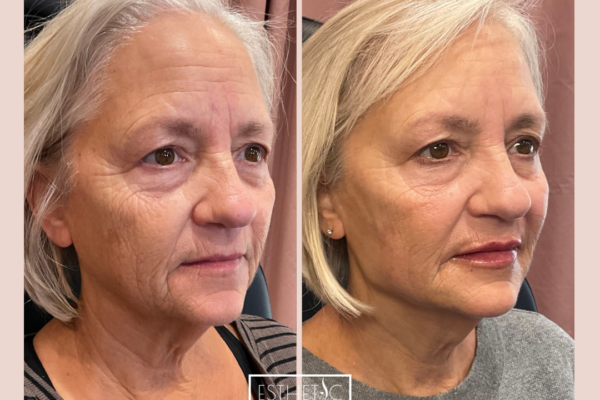 Julie Wilkens Full Restore Botox, Cheek filler, Jawline, Chin, Lips_20250103_035828_0002 Before and after Botox results in Phoenix at Esthetic Finesse