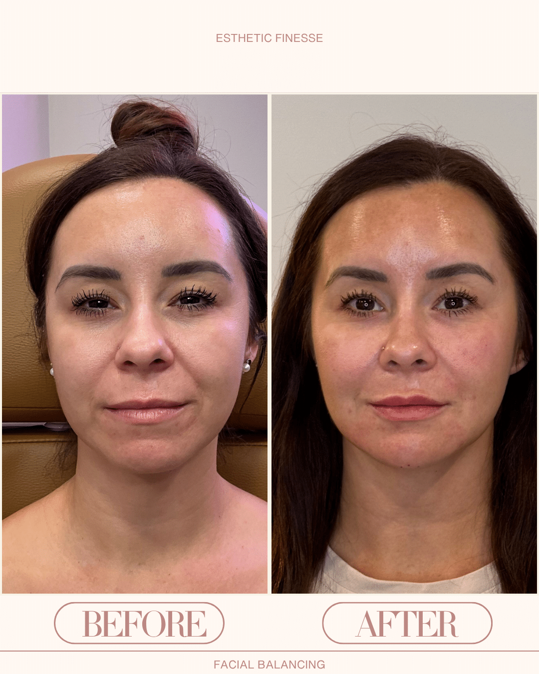 facial balancing in scottsdale results