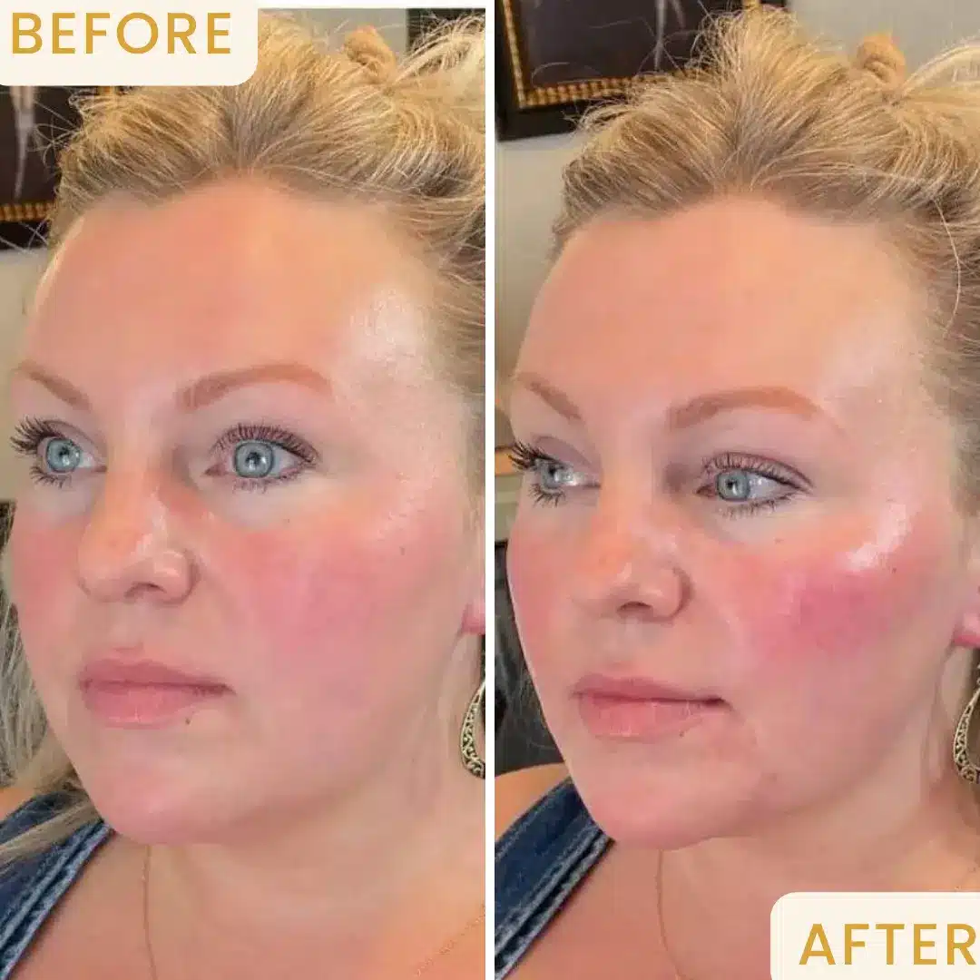 Full-face dermal filler transformation – lips, jawline, and midface volume enhancement