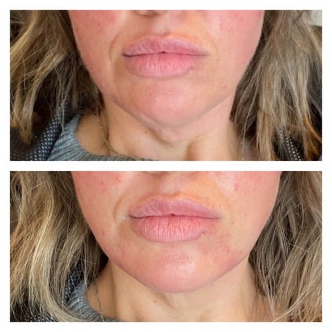 Scottsdale med spa client receiving lip filler consultation and treatment plan