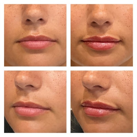 Before and after lip filler treatment in Scottsdale – natural volume and symmetry